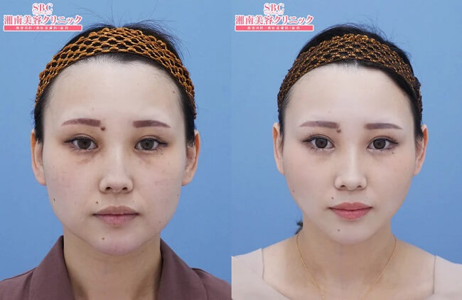 名倉俊輔医師バッカルファット除去+アキーセル脂肪吸引の症例写真
