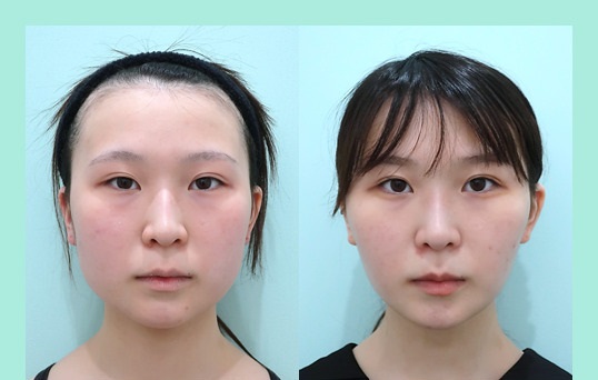 WOM CLINIC GINZA(ワムクリニックギンザ)頬と顎下の脂肪吸引症例