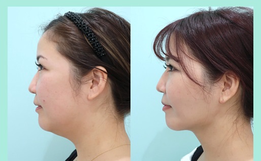 WOM CLINIC GINZA(ワムクリニックギンザ)頬と顎下の脂肪吸引症例