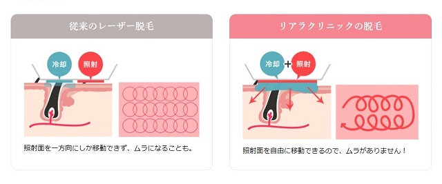リアラ脱毛イメージ