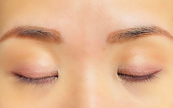 二重の埋没はまぶたが厚いと取れやすくなる