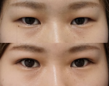 もとび美容クリニック埋没症例写真