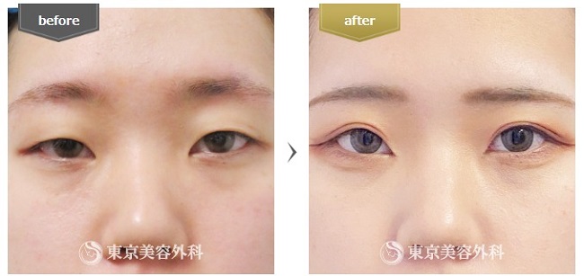 東京美容外科の切開法症例写真