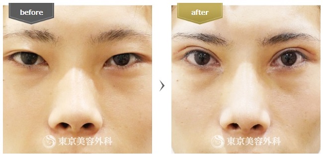 東京美容外科の切開法症例写真