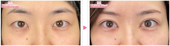SBC切開法症例写真