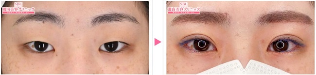 SBC切開法症例写真