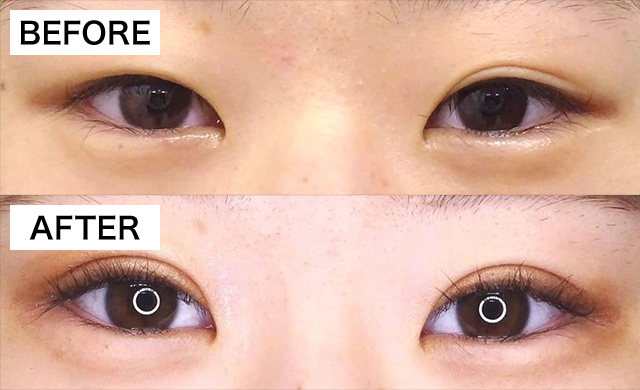 TCB東京中央美容外科クリニック切開法症例