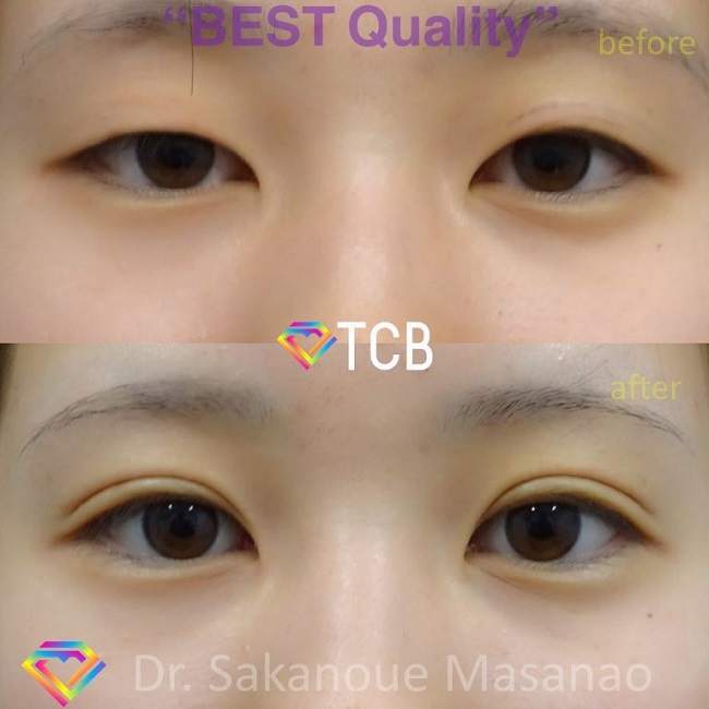 TCB二重埋没法症例
