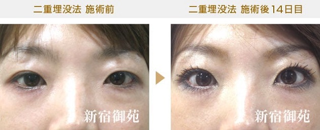 新宿御苑美容クリニック二重症例写真