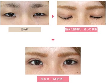 大塚美容形成外科二重症例写真