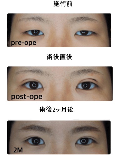 S.T style クリニック二重症例写真
