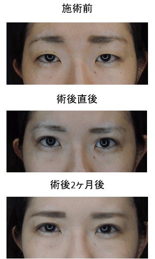 S.T style クリニック二重症例写真