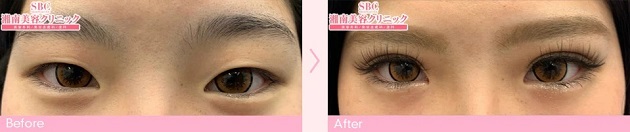 湘南美容クリニック二重症例写真