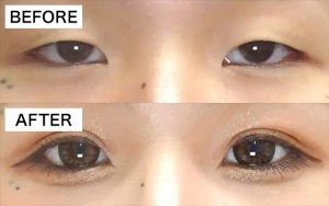 TCB東京中央美容外科二重症例写真