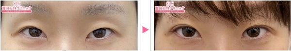湘南美容外科_埋没法施用例