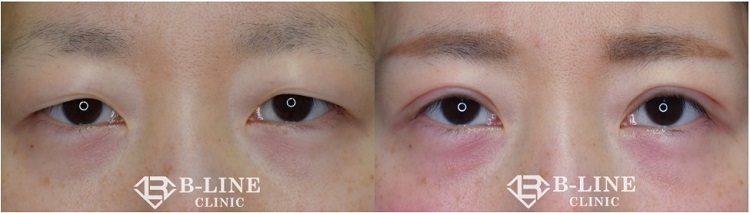 B-LINE CLINIC埋没法症例
