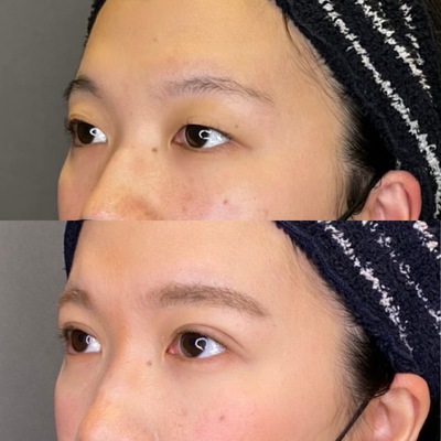東京美容医療クリニック埋没法症例
