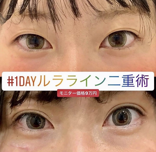 ルラ美容クリニック埋没法症例