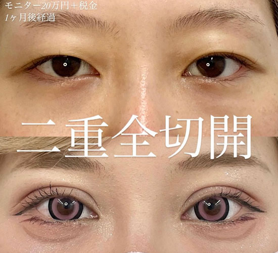 ルラ美容クリニック切開法症例