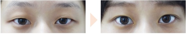 みずほクリニック埋没法症例写真