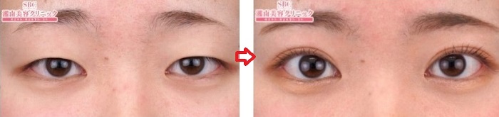 湘南美容外科_埋没法症例