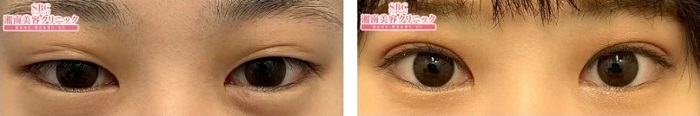 湘南美容外科_埋没法症例