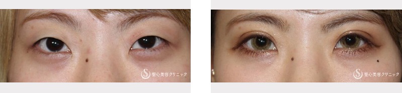聖心美容外科クリニック_埋没症例