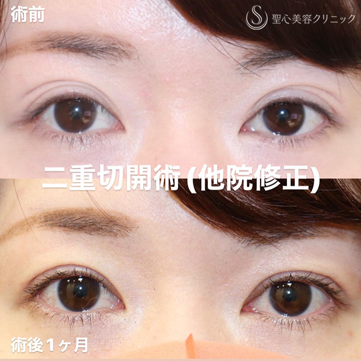 聖心美容外科クリニック_切開症例