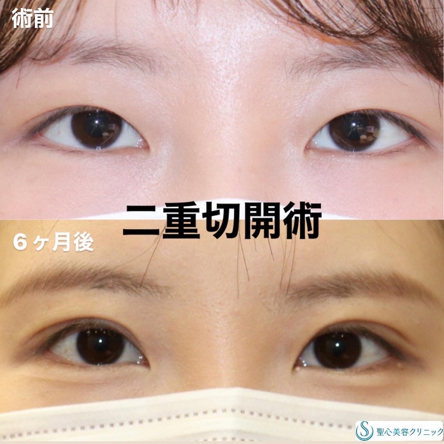 聖心美容外科クリニック_切開症例