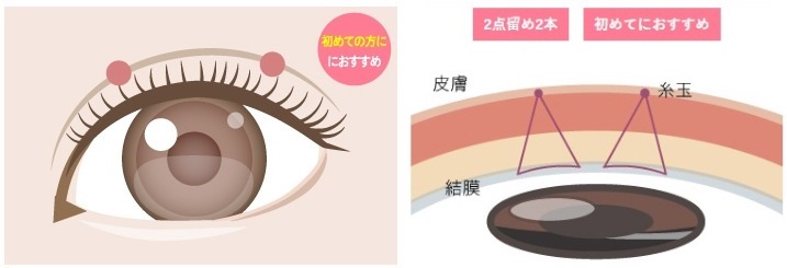 ベリンダクリニック BELINDA二重術 スタンダード