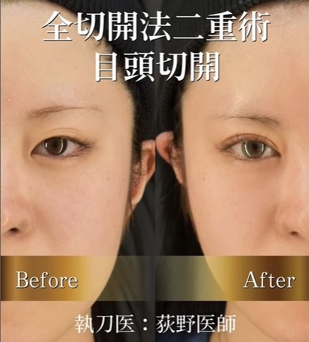 HAAB DRAEM BEAUTY CLINIC全切開症例