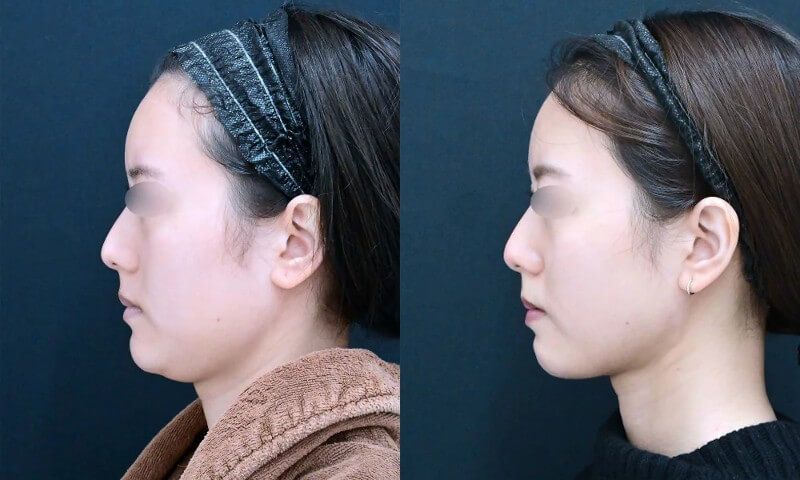 湘南美容クリニック秋葉原院の顔の脂肪吸引症例写真2