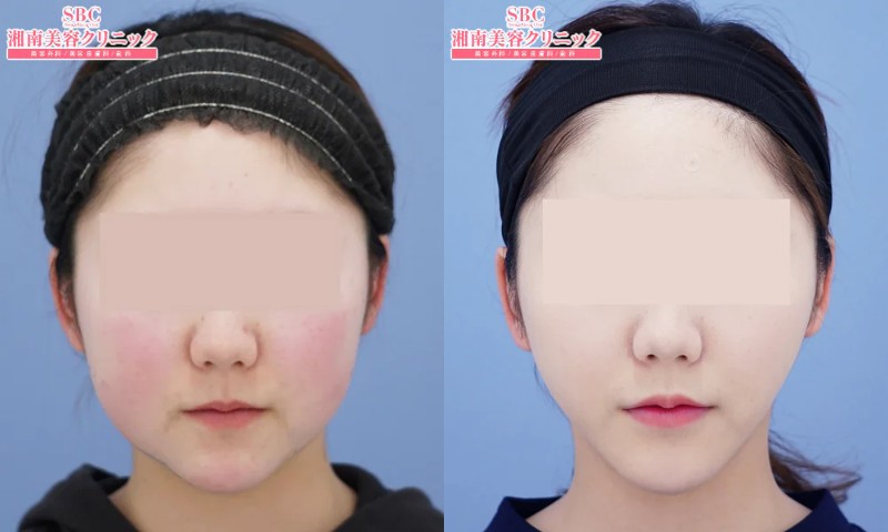 湘南美容クリニック秋葉原院の脂肪吸引症例1