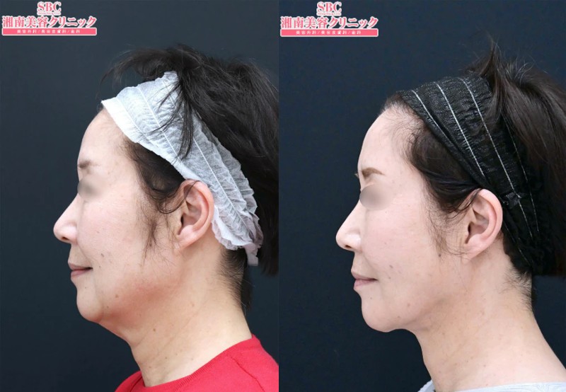湘南美容クリニック秋葉原院の脂肪吸引症例2