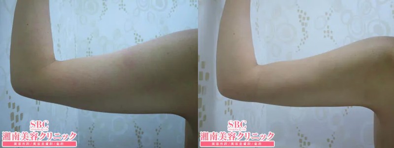 湘南美容クリニック新橋銀座口院の脂肪吸引症例1