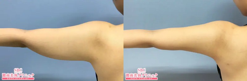 アキーセルの症例写真1