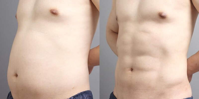 THE CLINIC男性の脂肪吸引の症例1