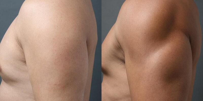 THE CLINIC男性の脂肪吸引の症例2