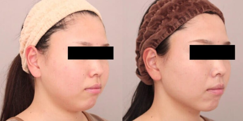Mods Clinicのベイザー脂肪吸引の症例写真2