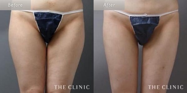 the clinic脂肪吸引症例