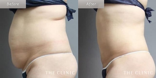 the clinic脂肪吸引症例