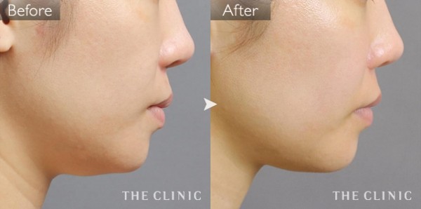 THECLINIC中居医師の顔の脂肪吸引症例写真