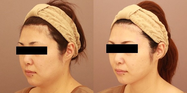 長野医師：顔の脂肪吸引症例写真