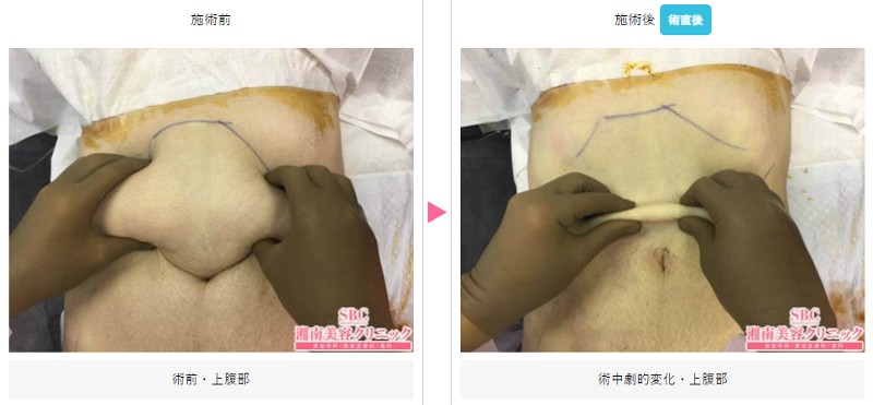 SBC竹田医師：お腹の脂肪吸引の症例3