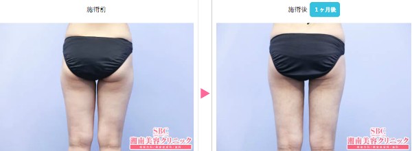 SBC新橋銀座口院：太ももの脂肪吸引の症例写真①