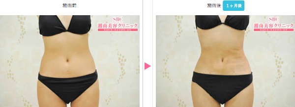 SBC新橋銀座口院：お腹の脂肪吸引症例写真②
